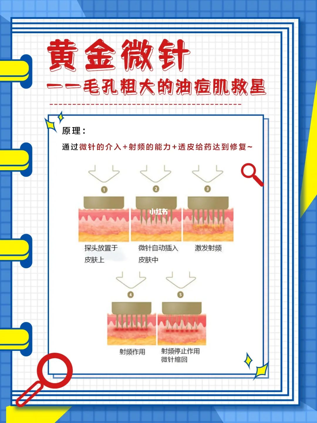 黄金微针的功效和作用加pap是什黄金微针的功效和作用-第1张图片-翡翠网