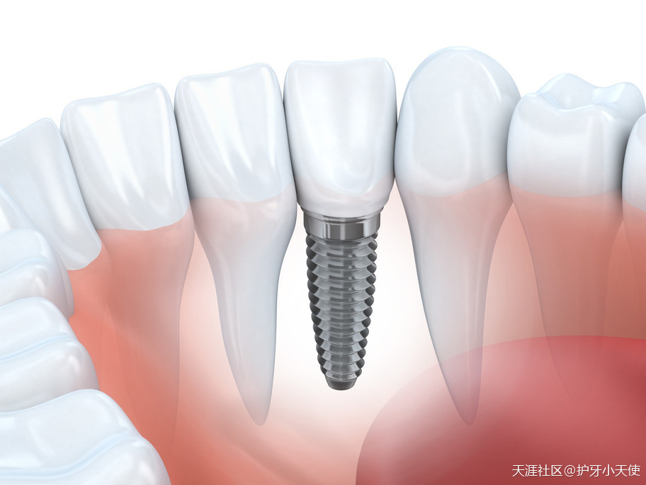 深圳一颗种植牙价格表-第1张图片-翡翠网