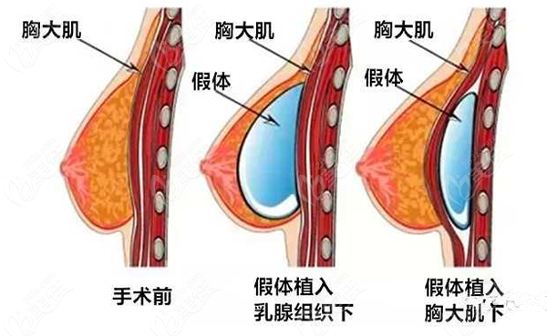 1月13日直播隆胸,隆胸手术直播录像-第1张图片-翡翠网