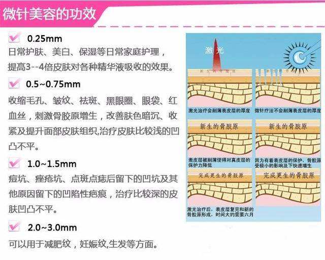 黄金微针的功效和作用瘦身黄金微针的功效和作用-第1张图片-翡翠网